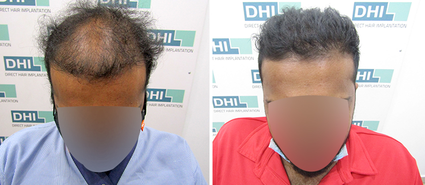 DHI before & after hair transplant results